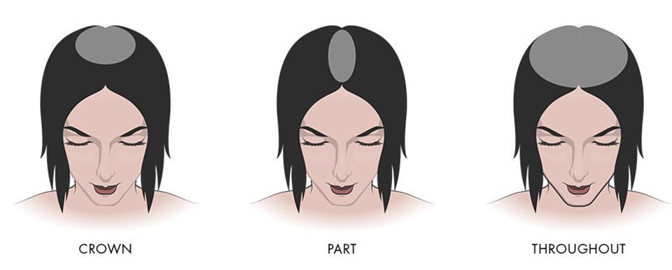 Area of Hair Loss